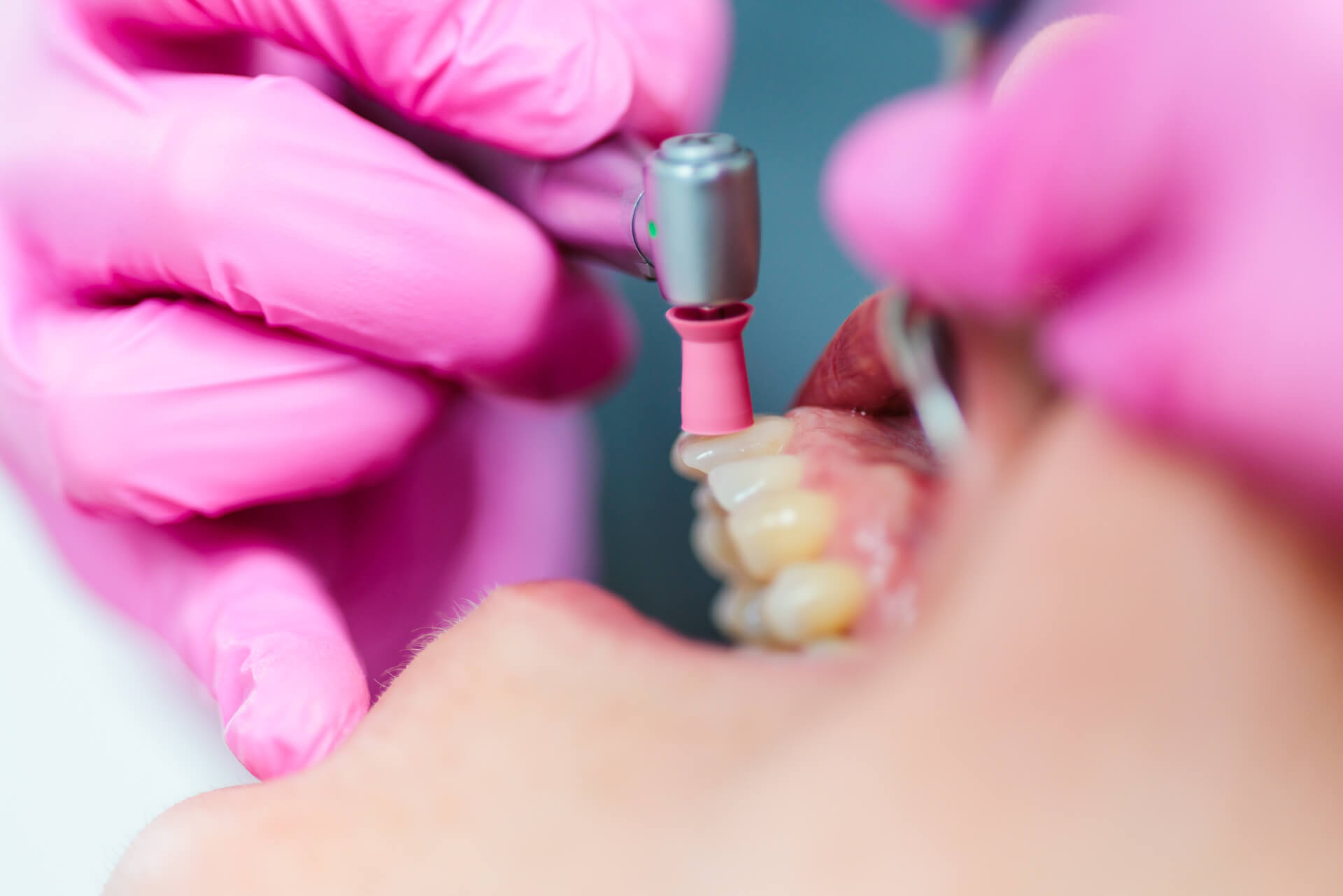 Prophylaxe | Zahnarztpraxis in Rietberg